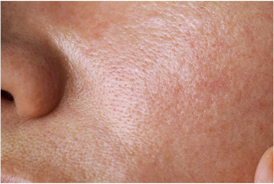 Pelle grassa? Scopri le cause e la skincare routine adatta per trattarla
