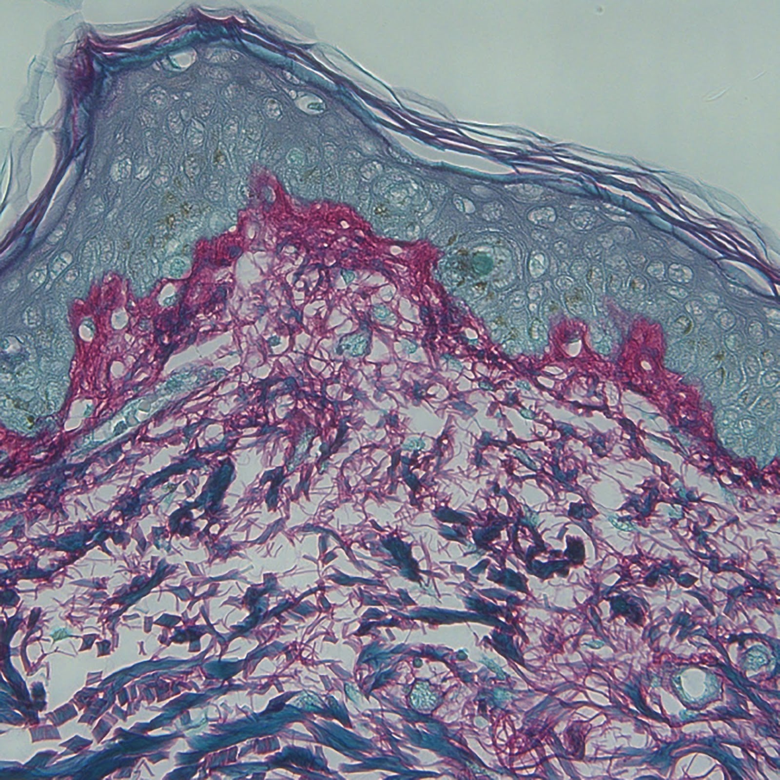 Cos'è la mesoterapia o biorivitalizzazione?